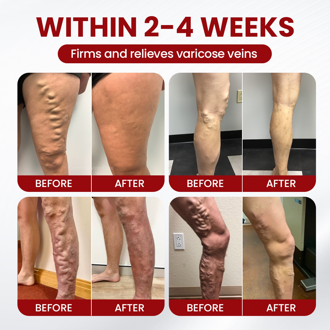 Timilk® Varicose & Spider Vein Relief Cream