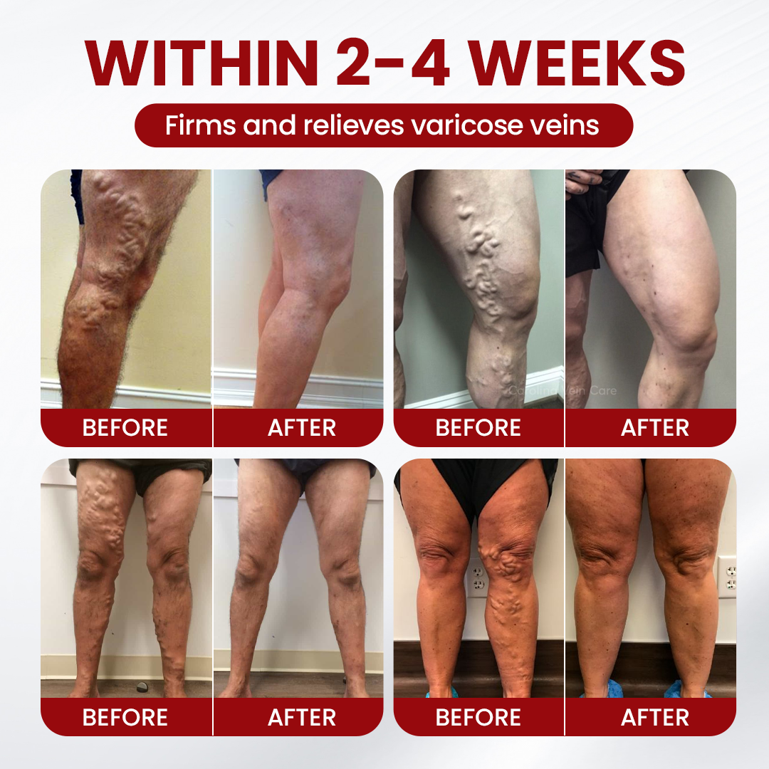 Timilk® Varicose & Spider Vein Relief Cream