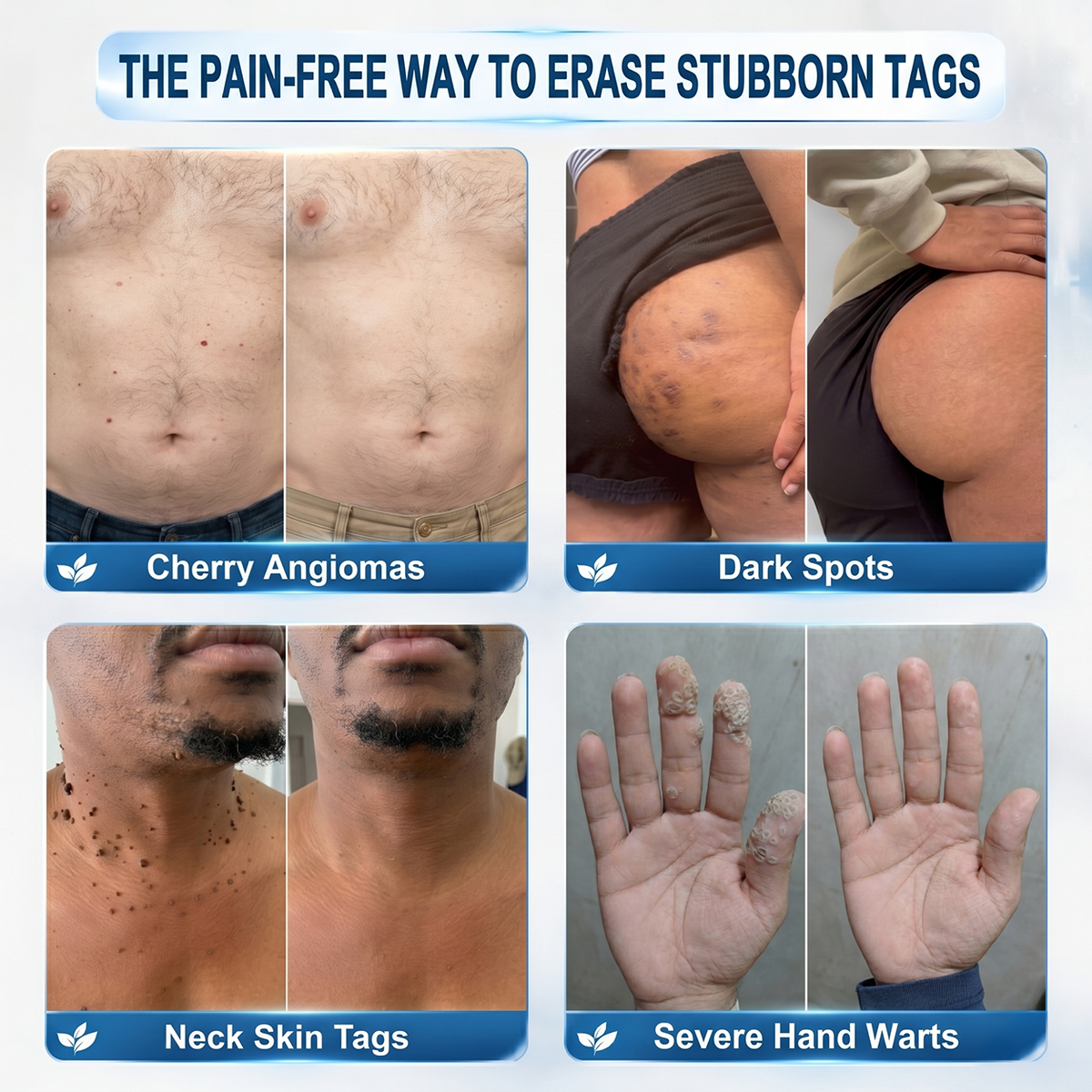 Picdo® 7-Day Tag & Spot Eraser (Zero Pain, Zero Scars Rollerball)