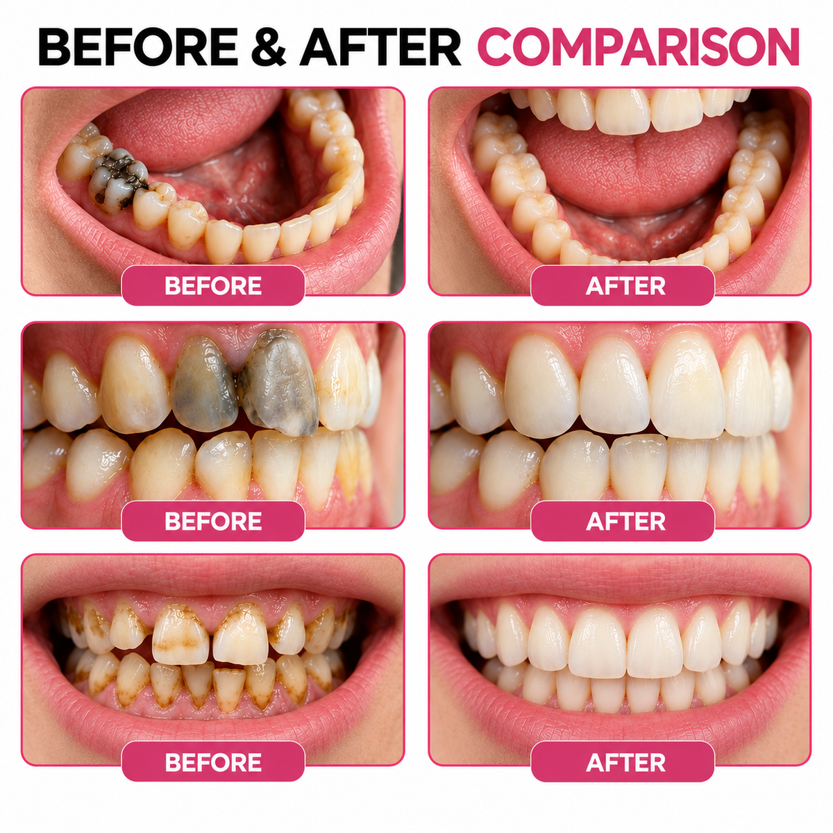 DenPerm® Cavity-Repair Natural Enamel Filling Gel