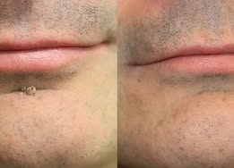 Curalona® 2-in-1 Microneedle & Hydrocolloid Patch (Removes Raised Moles, Acne, Flat Warts & Skin Tags | Helps Improve Wrinkles, Scars & Blemishes | Invisible Patches for Face & Body)