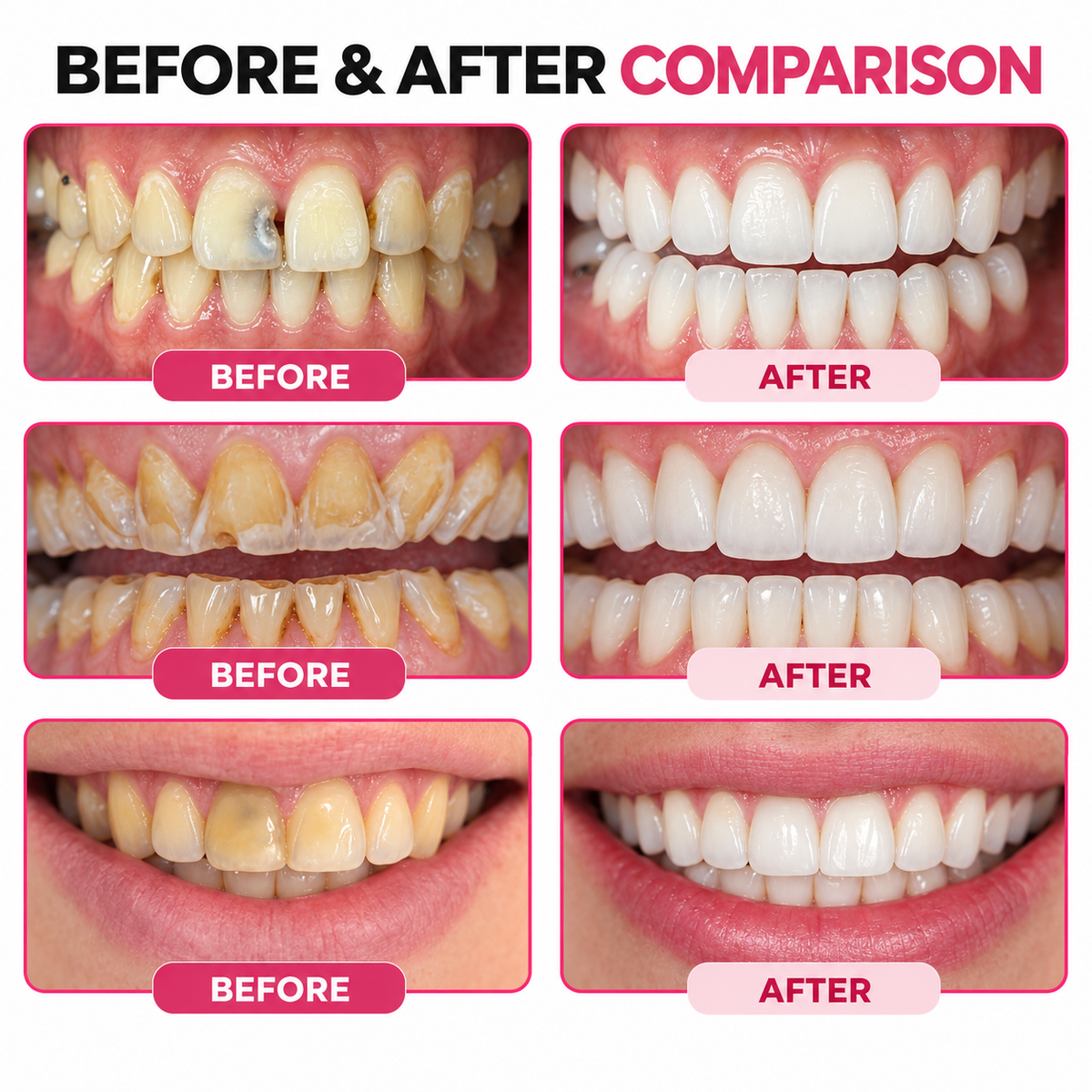 DenPerm® Cavity-Repair Natural Enamel Filling Gel