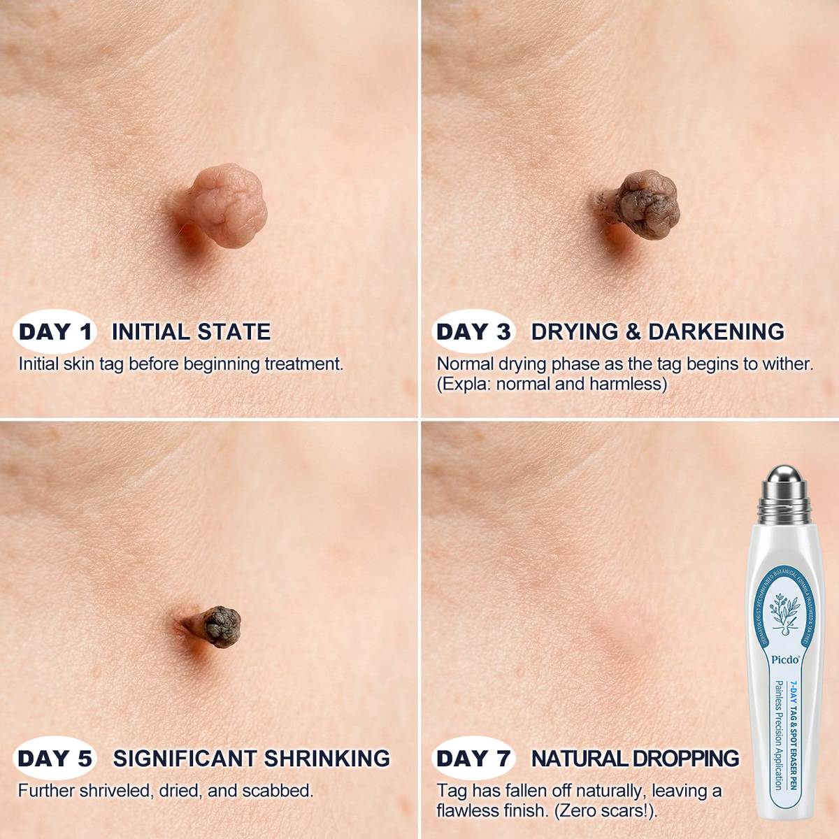 Picdo® 7-Day Tag & Spot Eraser (Zero Pain, Zero Scars Rollerball)
