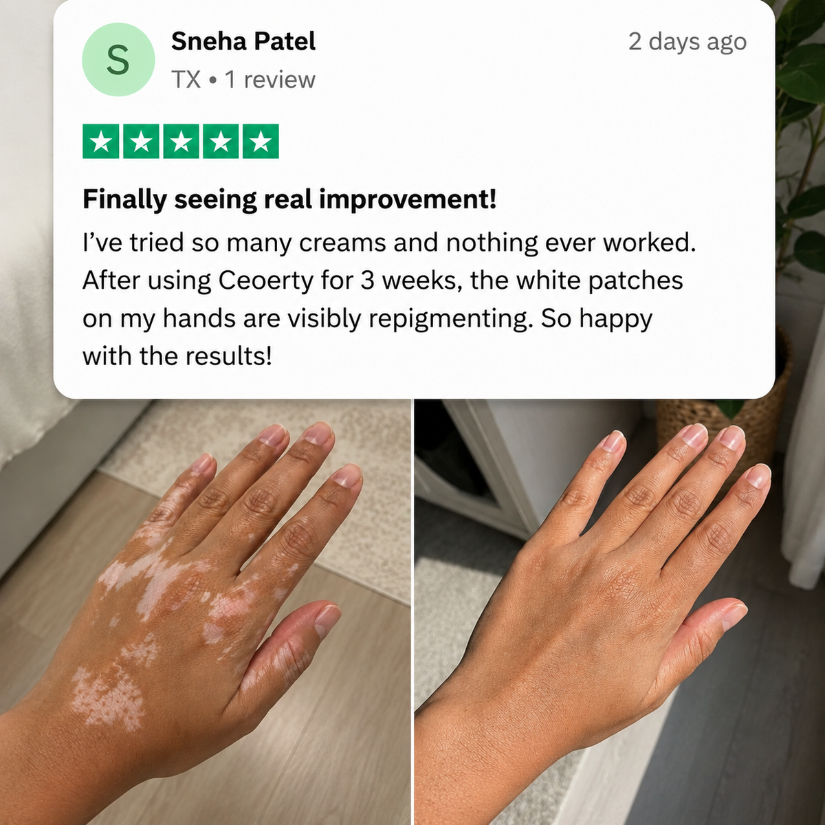 Ceoerty® Herbal Vitiligo Cream
